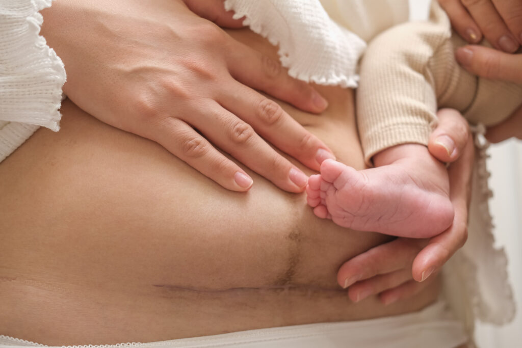 c-section recovery physical therapy in Warrington