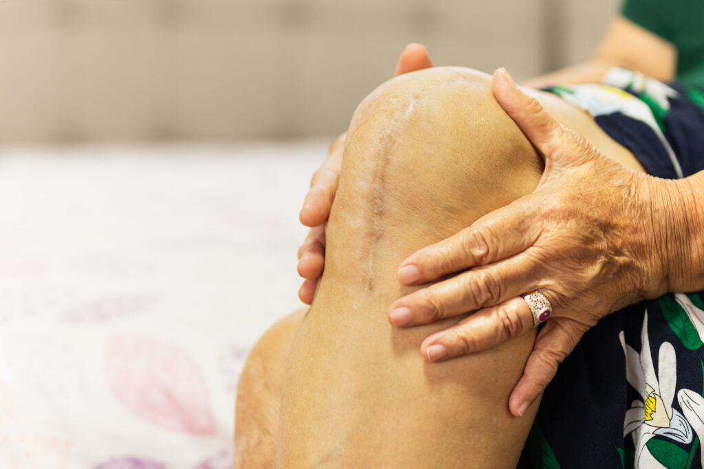 how long is rehab after knee replacement surgery